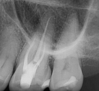 Root Canal