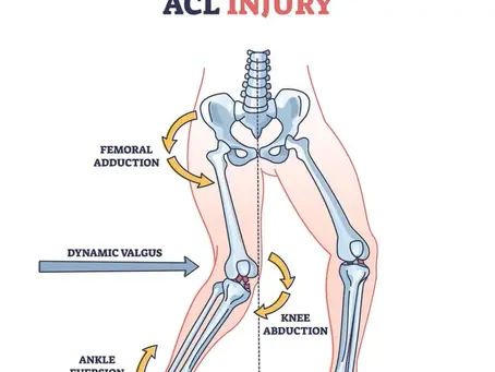 How to Prepare for ACL Surgery: From Diagnosis to Recovery