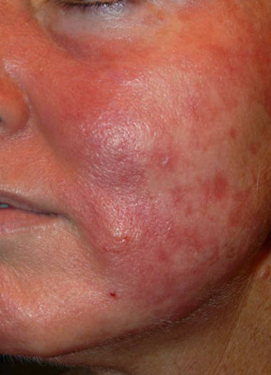 Non sbagliare!Mi sono rovinata la pelle con una crema alla vitamina A, ma poi ho trovato un prodott