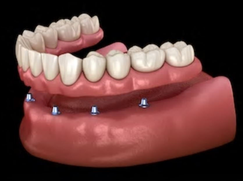 PRÓTESIS REMOVIBLE SOBRE IMPLANTES