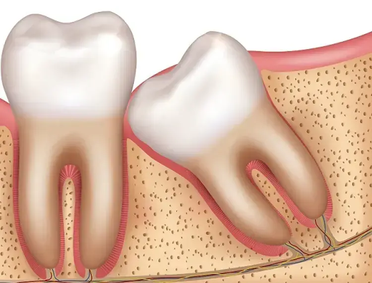 Wisdom Tooth Pain: When Should You Remove It?