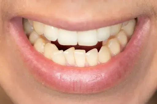 teeth movement in adults, why teeth shift with age, shifting teeth adults, adult teeth crowding, missing teeth shifting, teeth grinding tooth movement, adult orthodontic treatment, aligners for shifting teeth, Oyster Dental Care Chennai, best dentist Anna Nagar Chennai