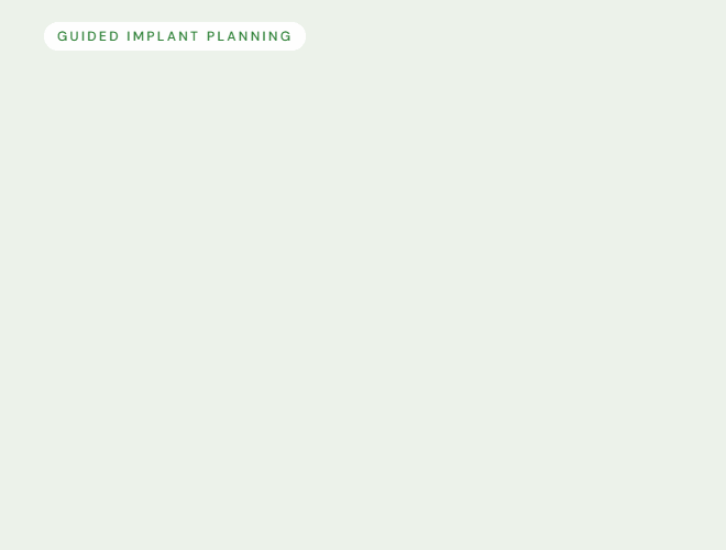 Guided implant planning