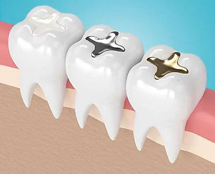 Cosmetic Fillings