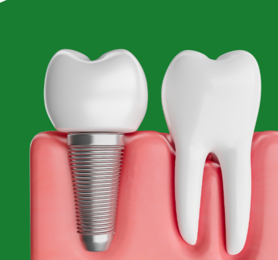 implant model