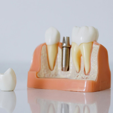 Is It Ever Too Late for Dental Implants? What Older Adults Need to Know