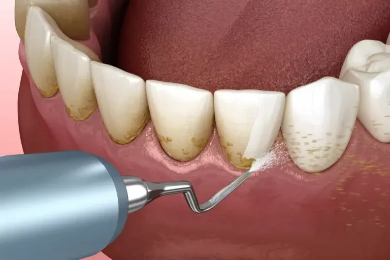 Deep cleaning