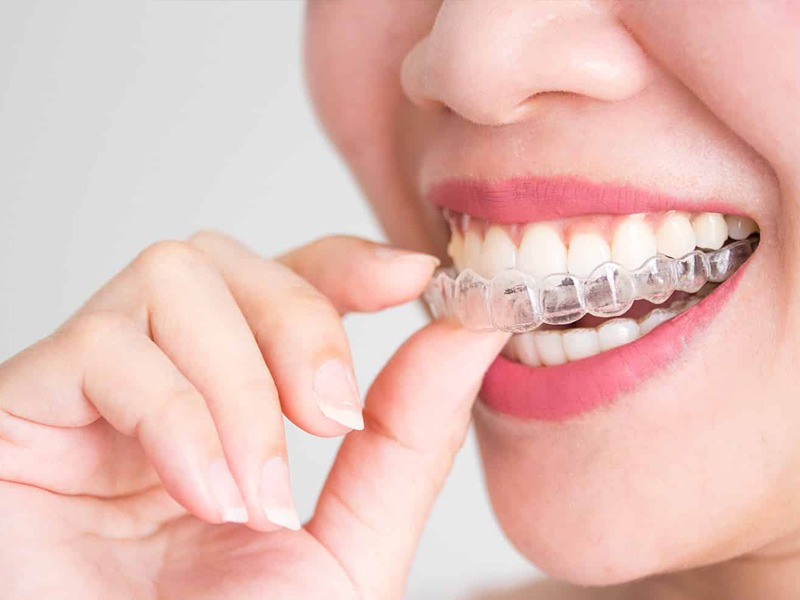 clear aligner