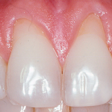Les récessions gingivales