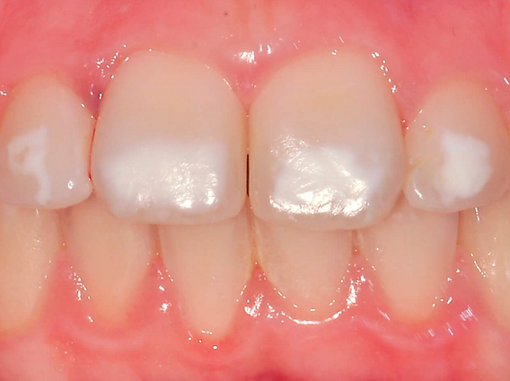 Taches Blanches sur les Dents: Causes, Traitements et Prévention