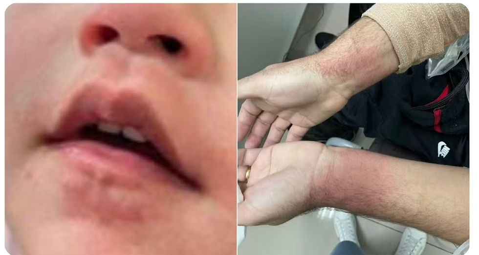 Criança de dois anos ficou com queimaduras nos lábios e seus pais com outras reações alérgicas, após serem atigidos por spray de pimenta durante missa em Jundiaí