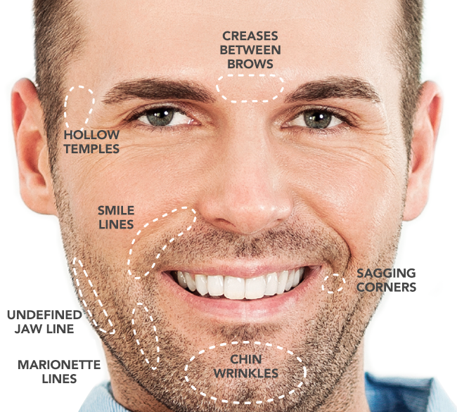 FILLERS
