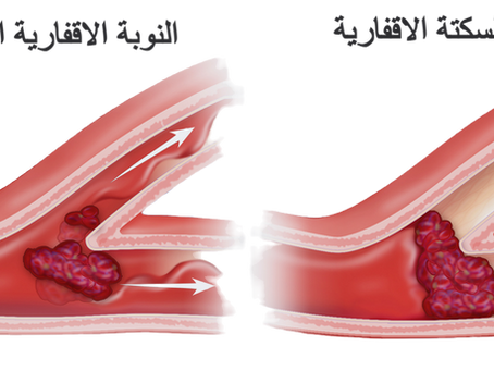 النوبة الإقفارية العابرة