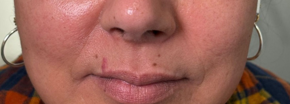 prf for face Houston.jpeg, Mila's Aesthetic Med Spa