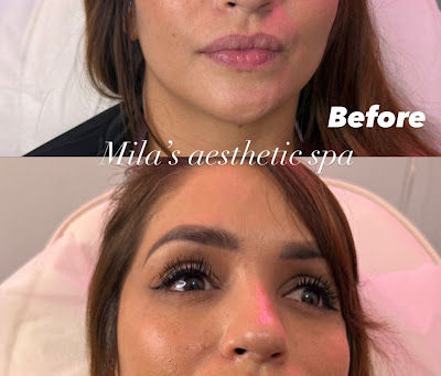 Tips To Botox Around Eyes Houston TX: Cosmetic Wrinkle Filler