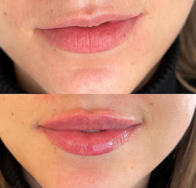 Dermal Fillers On Cheeks Houston- Mila's Aesthetic Spa