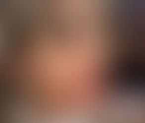 Houston TX: Botox Jaw Slimming and Jawline Contouring