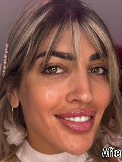 botox to slim face Houston.jpg