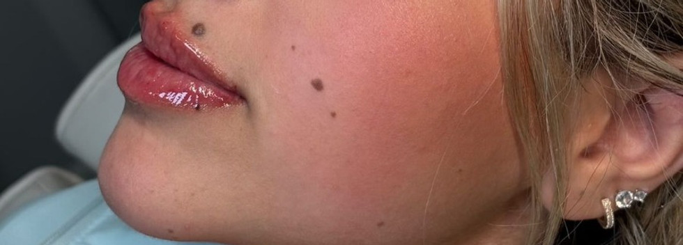 Botox to slim face H houston.jpeg, Mila's Aesthetic Med Spa