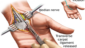 What is this Carpal Tunnel Syndrome (CTS) ?