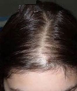 Hair loss for women