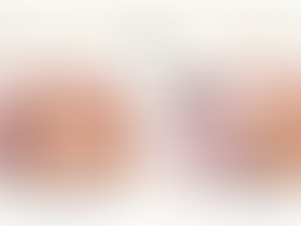 Microneedling vs. Radiofrequenz: Welche regenerative Technologie ist die richtige für Sie?