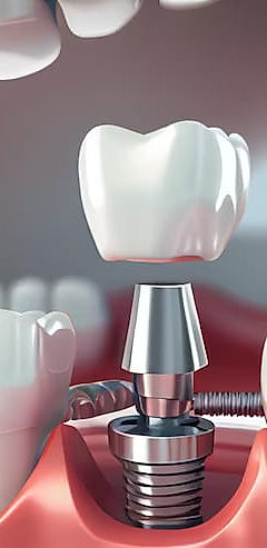 dental-implant-in-cedar-park-tx-town-center-dental-cedar-park.jpg