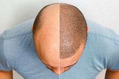 Hair Tranplanet Egypt Medical Packakeges Travel Tourism.jpg