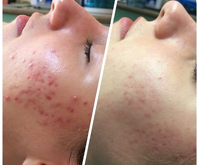 F-ACN 3 Treatments.jpg