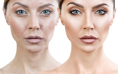 Microneedling.jpeg