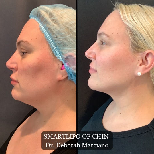Smartlipo Neck
