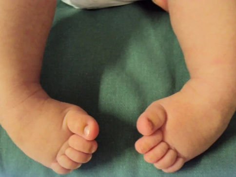 Pé torto congênito: dúvidas e tratamentos