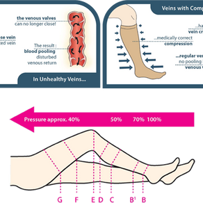 Compression Stockings Cut Off Circulation?