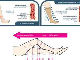 Compression Stockings Cut Off Circulation?
