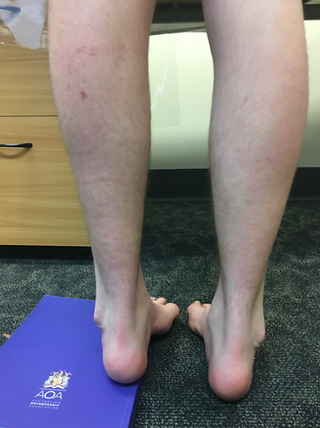 Photo of the patients lower leg from behind