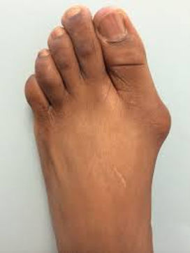 bunion2.jpeg