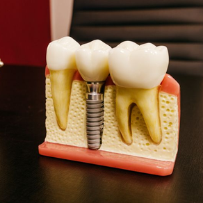Dental Implant: A Radiant Smile Awaits