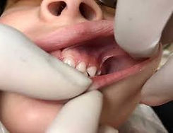 Tongue tie treatment in San Francisco