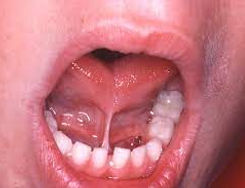 Tongue tie doctor in San Francisco