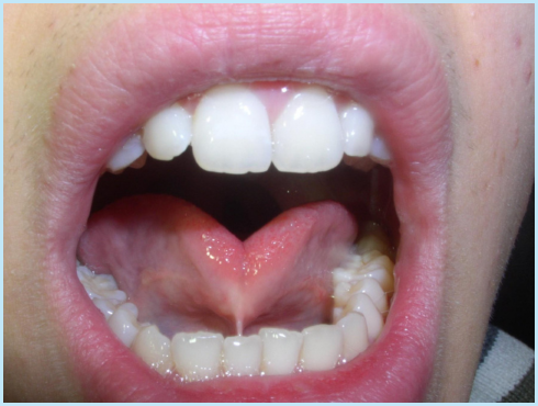 Tongue tie treatment in San Francisco