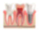 The Key to Long-Lasting Tooth Implant:Aftercare and Maintenance