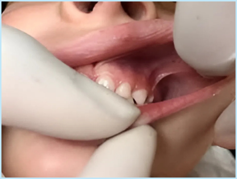 Tongue tie doctor in San Francisco