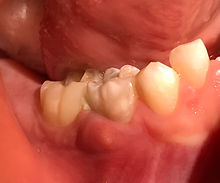 Dental Abscess