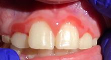 Bleeding Gums
