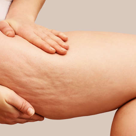 Lets talk cellulite