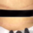 Before and after one Custom Laser Scar Revision treatment