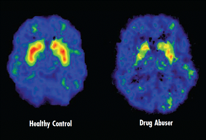 Image of two brains in a PET Scan, comparing a healthy persons brain to a person who uses drugs. The healthy brain has more areas lit up than the drug brain.