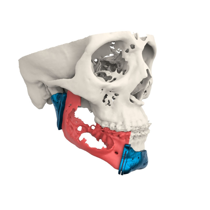 Guías de corte a la medida para reconstrucción mandibular