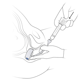 4. Hold and Fill.png