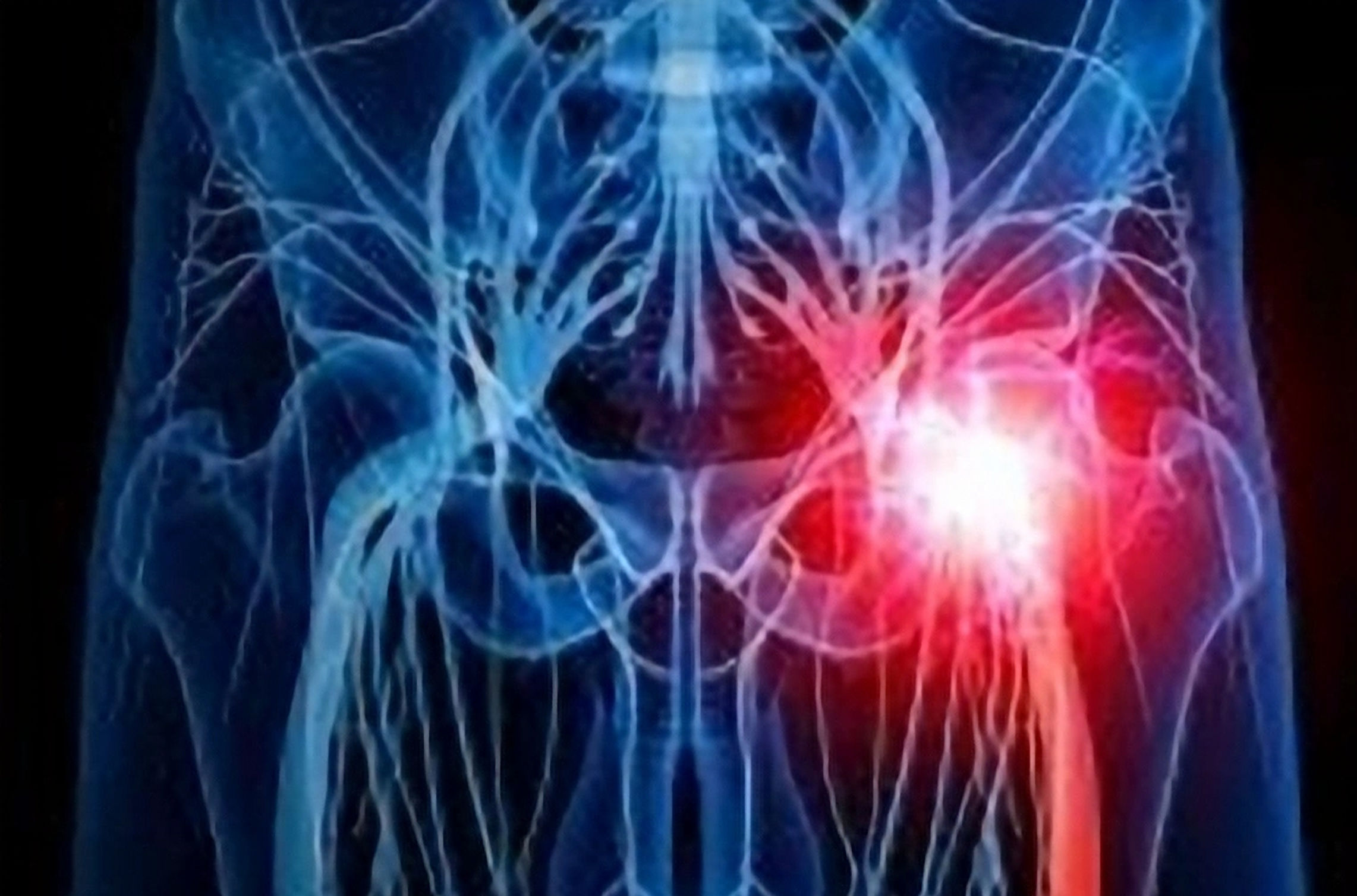 Managing Sciatica - 4 NCCAOM PDA Units